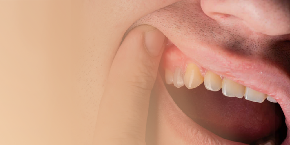 gum pain treatment at the best dental clinic in chennai