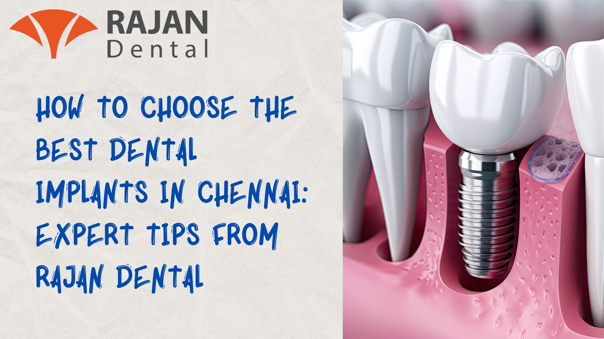 Best Dental Implants in Chennai