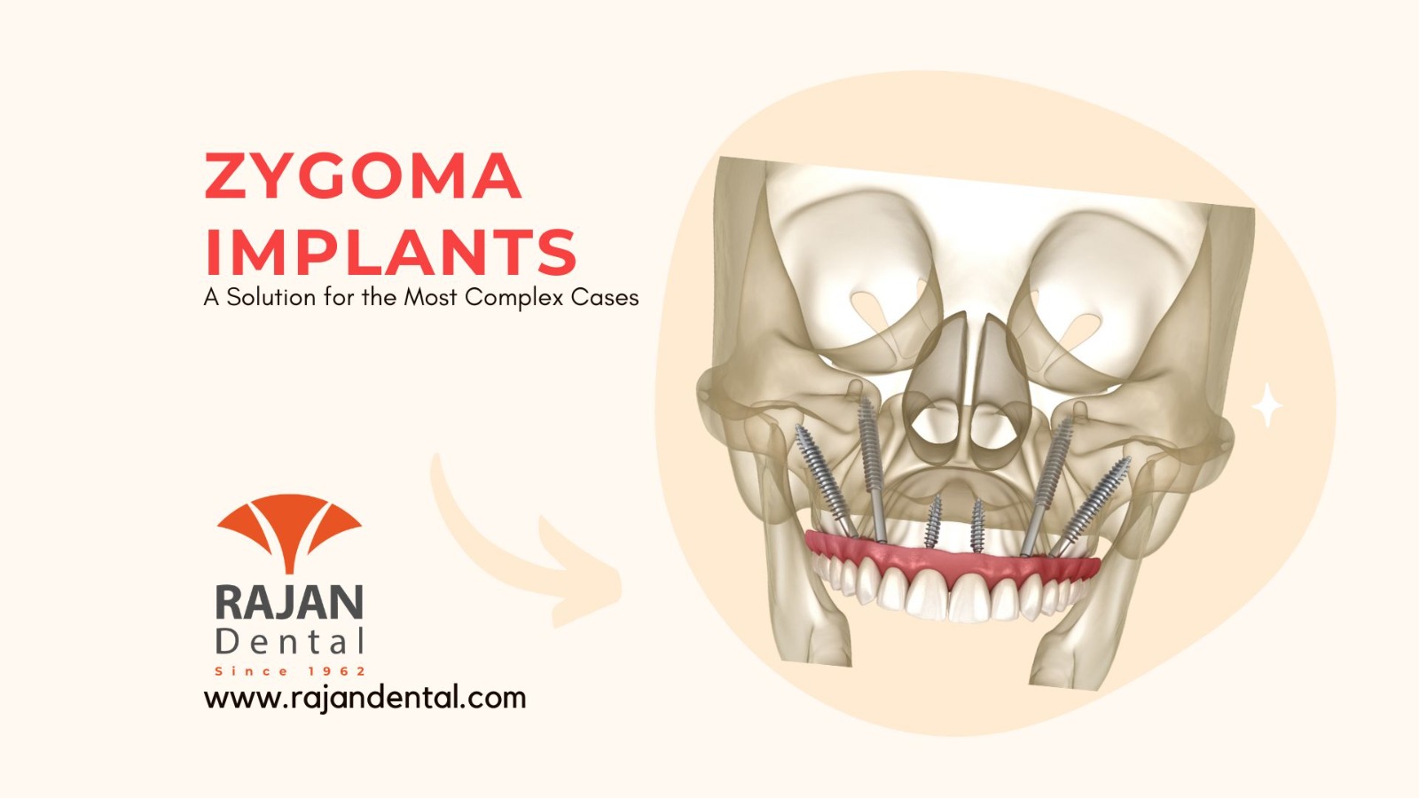 Zygoma Implants