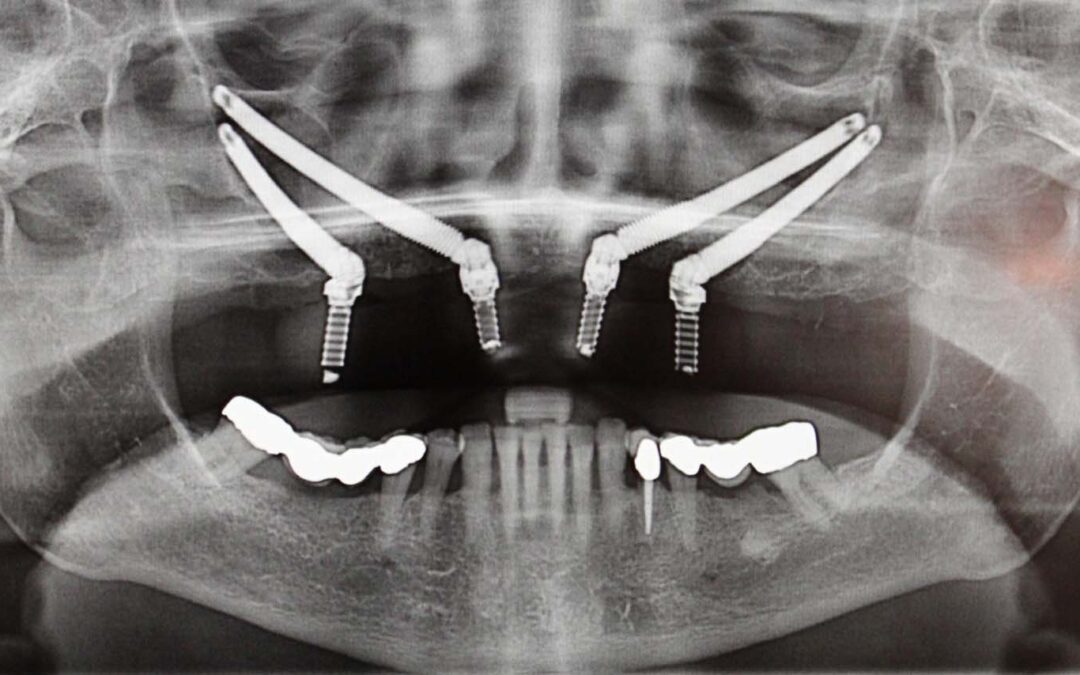 The Revolutionary Zygoma Implants at Rajan Dental