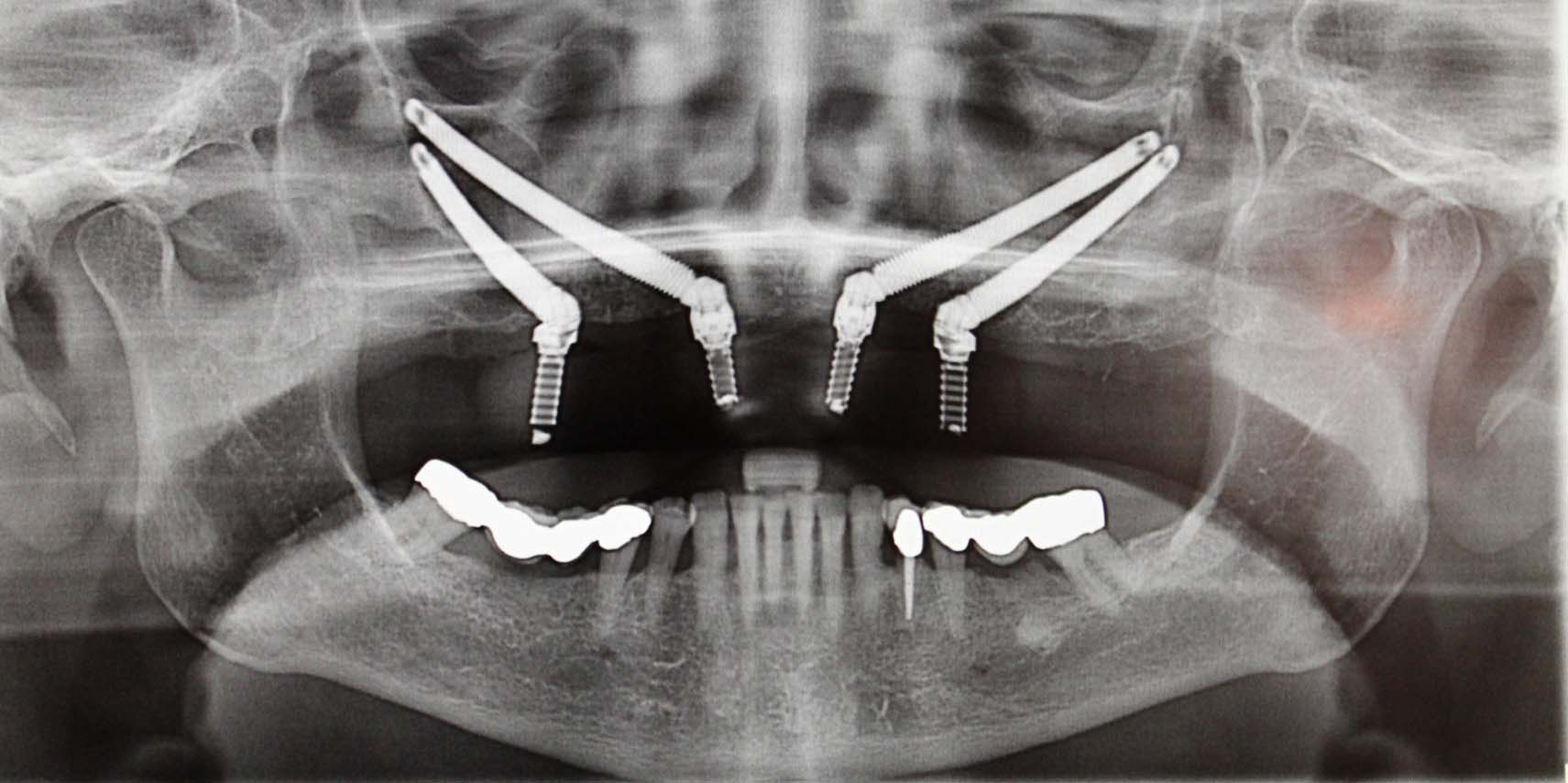 The Revolutionary Zygoma Implants at Rajan Dental
