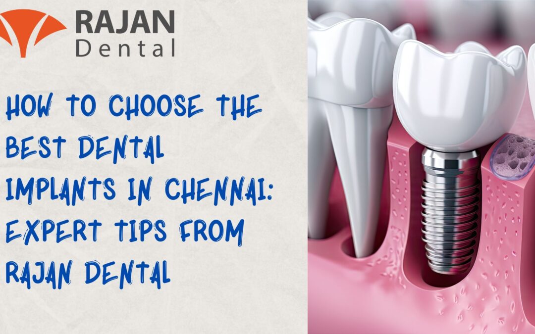 Expert Tips: Choosing the Best Dental Implants in Chennai