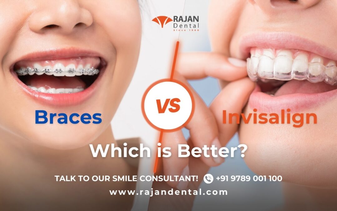 Top Benefits of Choosing Invisalign Over Braces