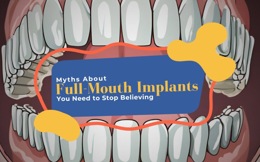 Myths About Full-Mouth Implants You Need to Stop Believing