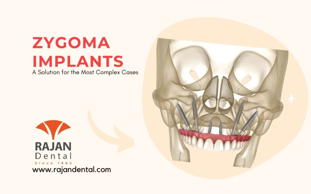 Zygoma Implants: A Solution for the Most Complex Cases
