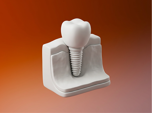 dental-implants