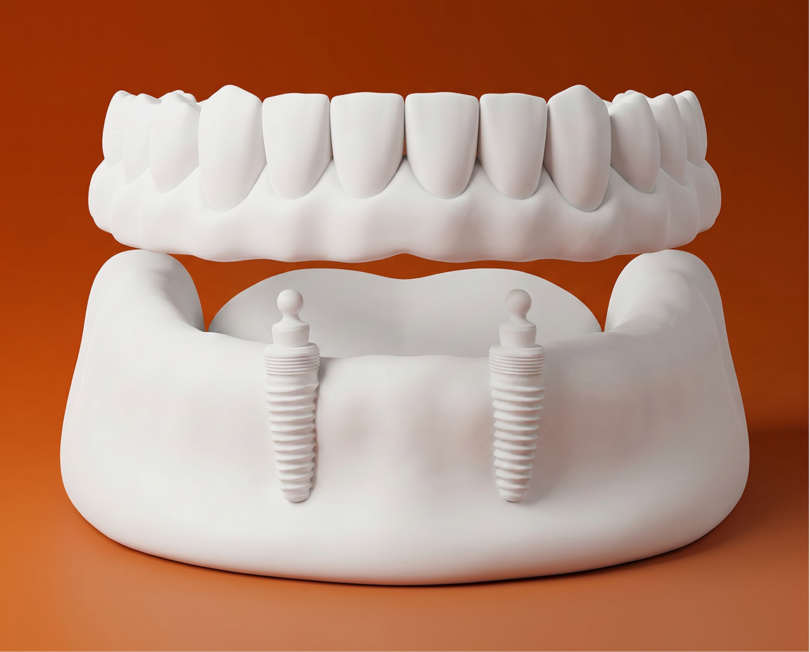 over-dentures